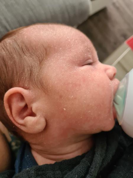 Jak se efektivně zbavit šupinek a suché kůže na tváři?