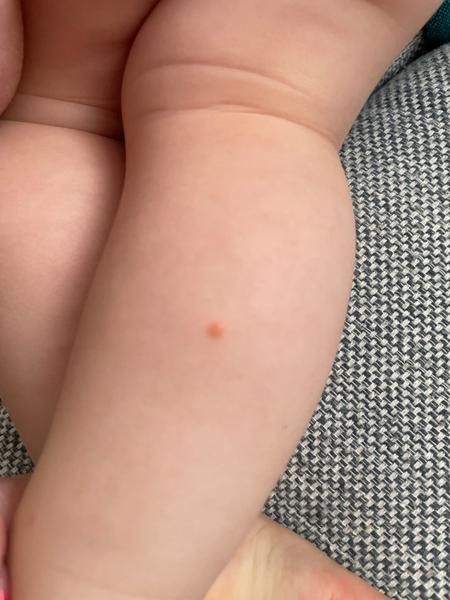 Co znamenají suché tečky po těle dítěte?