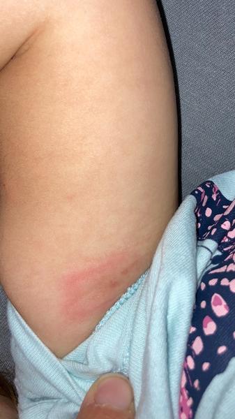 Mohla by to být borelióza?