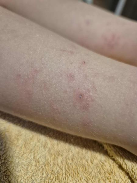 Neznámá vyrážka na nohou tříletého dítěte. Co by to mohlo být?