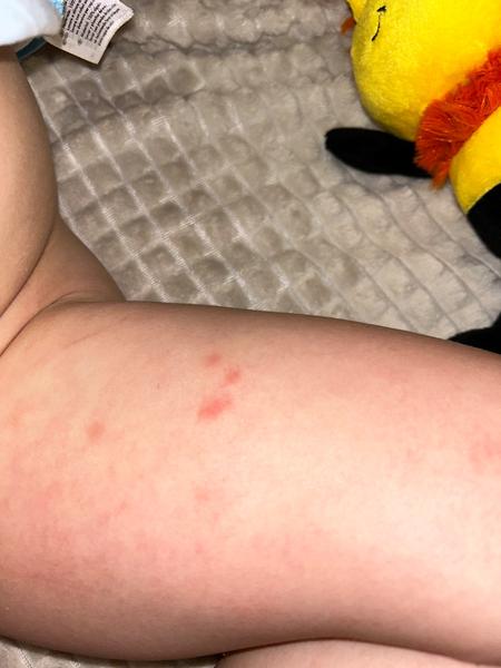 Locoid na atopický ekzém. Je to správné řešení?