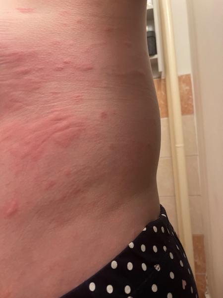 Alergie nebo kopřivka?