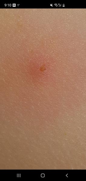 Vyrážka, infekce nebo neštovice. Poradíte, prosím, co by to mohlo být?