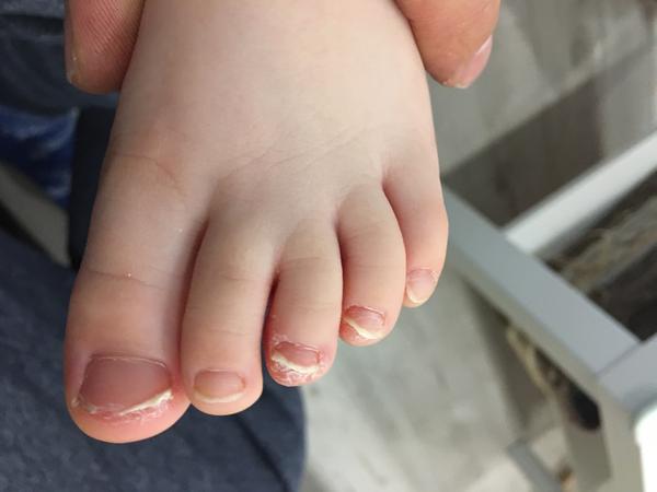 Plíseň na nohou. Může se o ni jednat?