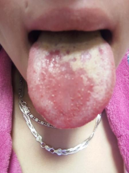 Bolest a pálení jazyka ve 33. týdnu těhotenství?