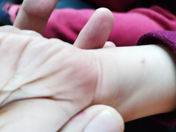 Puchýřky na rukou. Co by to mohlo být?