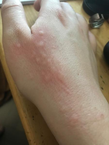 Svědivá kožní vyrážka: Co může být příčinou?