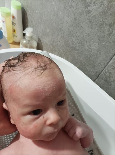 Kožní vyrážka a bílá mapa na čele při styku s vodou. Poradíte, prosím?