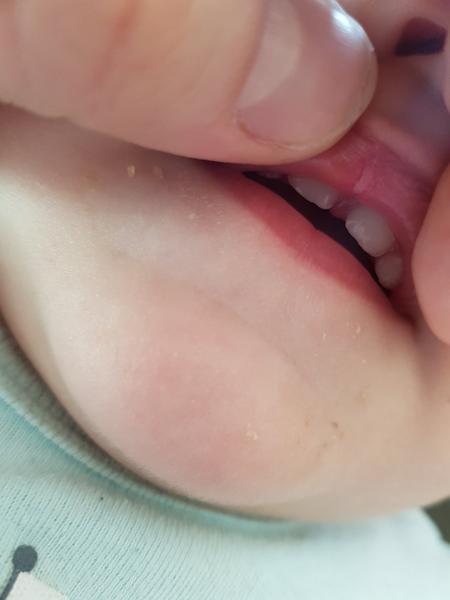 Čím namazat aft u 14měsíční dcery?