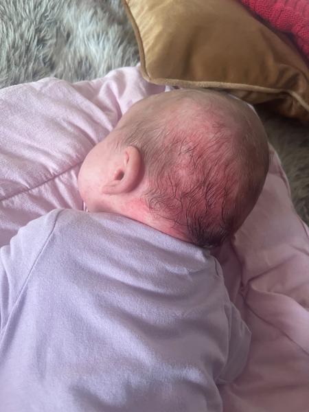 Akné u kojenců: Projevy a možné příčiny?