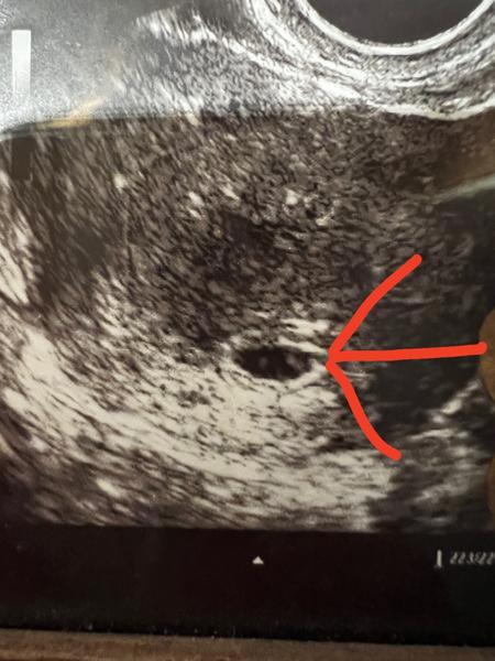 6. tt. Jedná se o plod, resp. embryo?