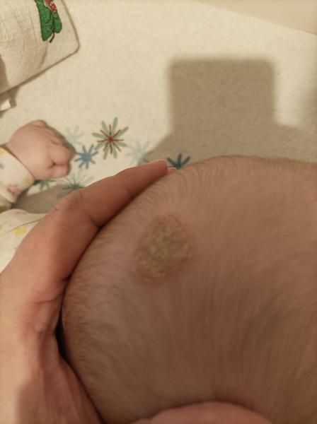 Ekzém, nebo něco jiného?