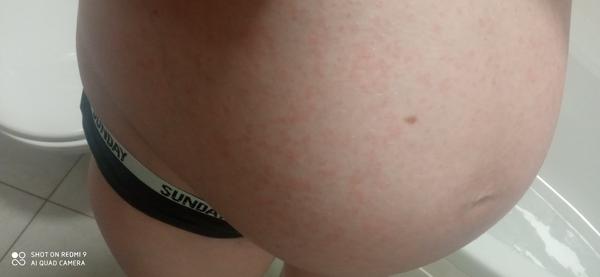 Vyrážka na břiše z ničeho nic🤷😳🤔. Poradíte, prosím?