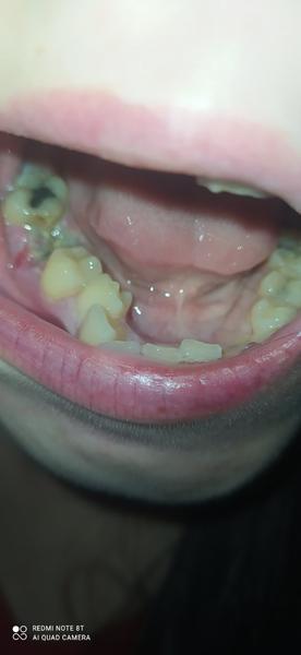 Co znamená šedivý povlak po extrakci zubu?