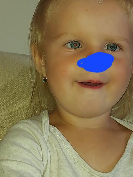 Flíček na tváři u 23měsíční: Co může znamenat?