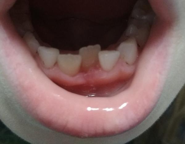 Druhý zub roste vzadu. Co byste poradila?