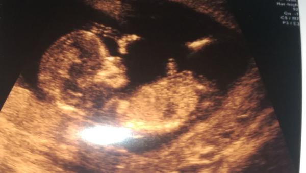 Pohlaví dle ultrazvuku