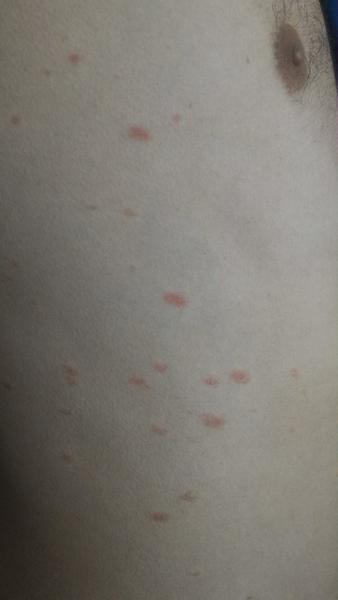 Poznáte tyto pupínky u dospělého?