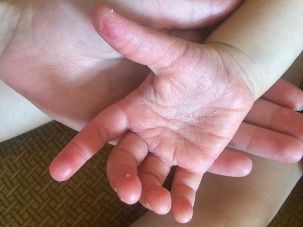 Drobné pupínky - je to plíseň nebo ekzém?