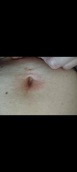 Je to erythema migrans nebo kvasinková infekce?