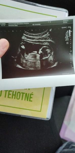 Poznáme pohlaví dítěte ze snímku ultrazvuku?