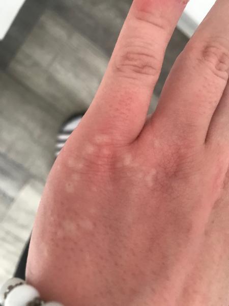 Je to svrab nebo něco jiného? Jak to poznat?