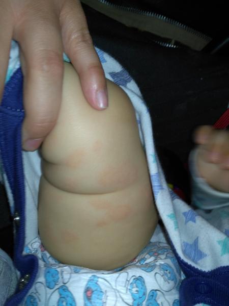 Kožní alergická reakce, z čeho by to mohlo být?