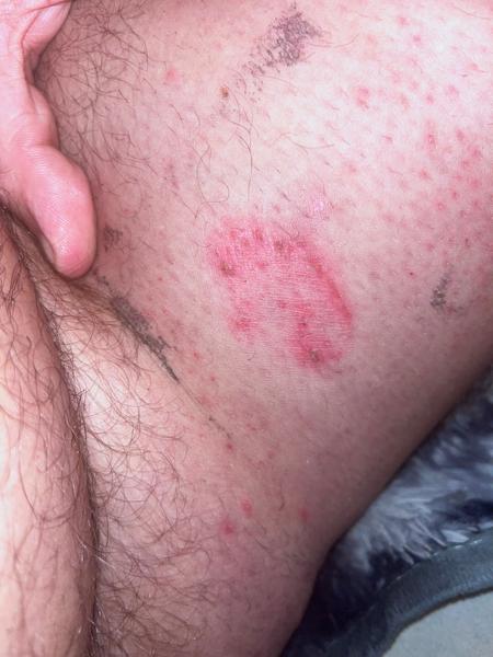 Kožní problém nezastavitelný a nereagující na kortikoidy. Co dělat?