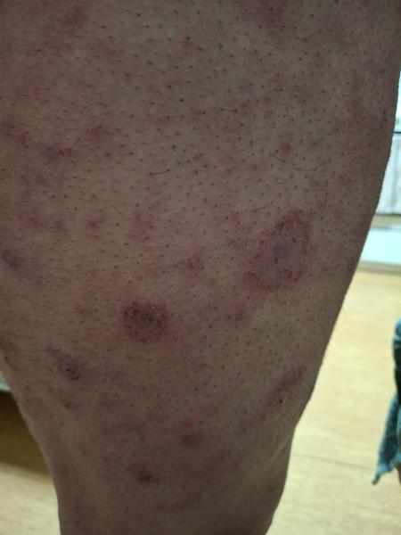 Neznámá kožní onemocnění a jejich obtížná léčba. Máte zkušenost?