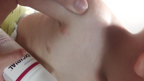 Vyrážka nebo ekzém. Poradíte, prosím, co by to mohlo být?