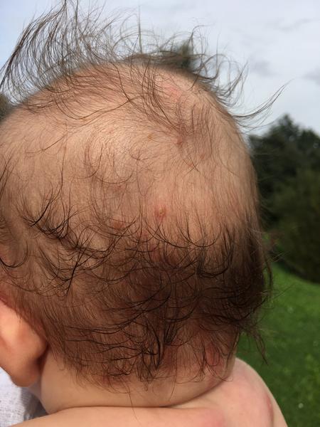 Boláky pod krkem. Zkušenosti? Prosím, pomůžete?