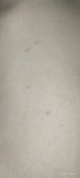 Záhadné pupínky u dcery. Může to být ekzém?