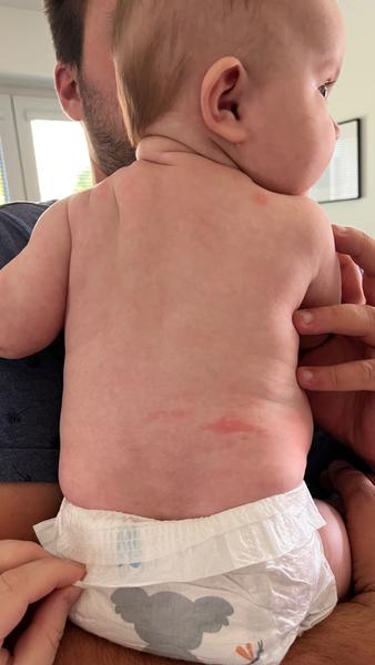 Červené fleky s bílým vnitřkem. Nemůže to mít souvislost s komplikacemi po porodu?