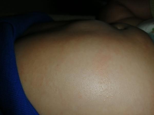 Je vyrážka na bříšku dítěte alergie nebo ekzém?