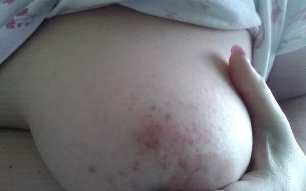 Co způsobuje bolestivou červenou skvrnu na prsu?