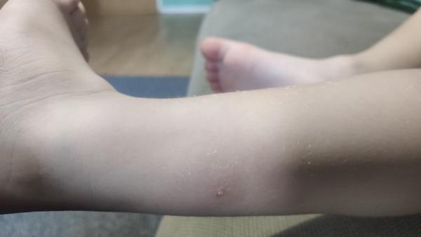 Nevíte, co je to za fleky na kůži?