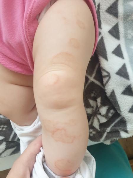 O jakou vyrážku se může jednat?