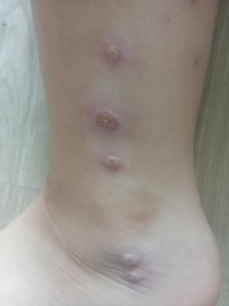 Je zelený hnis u neštovic normální? 