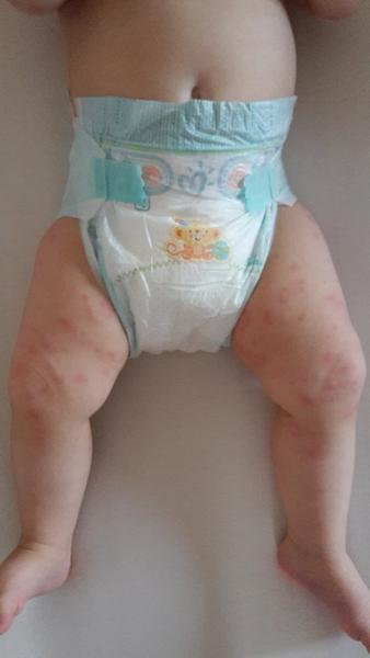 Kopřivka u ročního dítěte