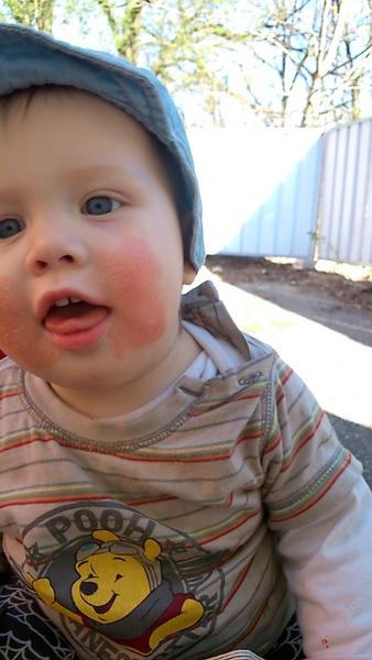 Ekzém na tvářičkách u roční dcerky. Poradíte, prosím, jak změnit stravování?