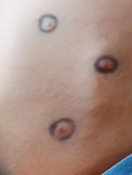 Jak správně léčit neštovice doma?