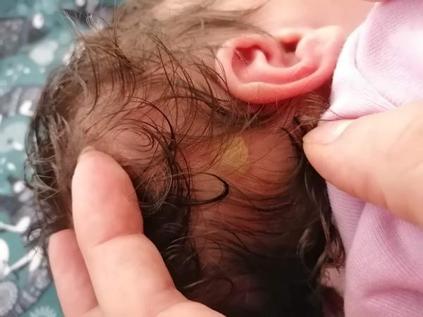 Puchýř. Co to může být?