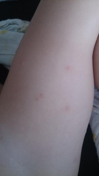 Mohou to být neštovice?