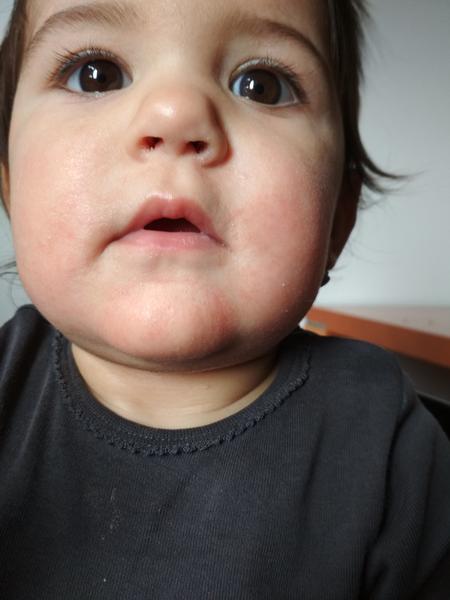 Trvající zarudnutí okolo úst u roční dcery. Prosím, poradíte?