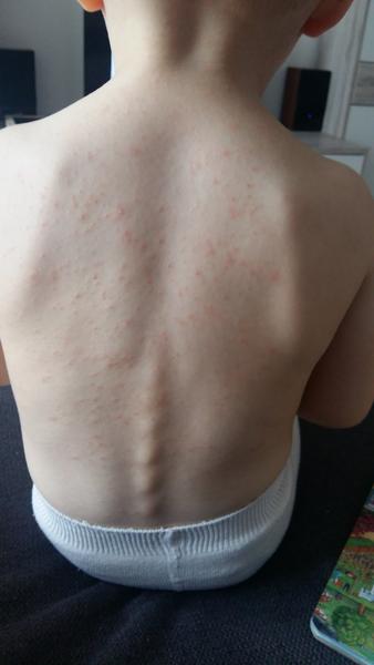 Dlouhotrvající vyrážka u 2letého dítěte. Může to být APEC?