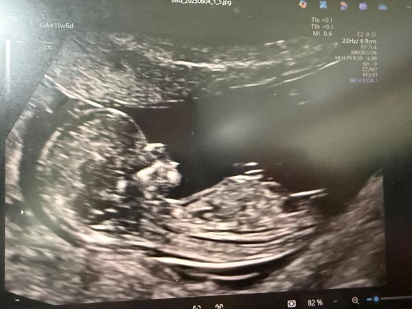 Pohlaví podle screeningu ve 12. týdnu. Co myslíte?