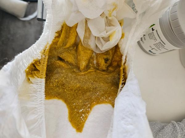 Řidší stolice ve 3,5 měsících. Mám to konzultovat s pediatrem?