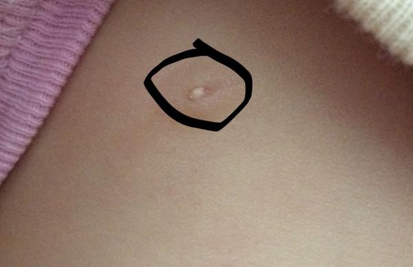 Vystouplá bradavka u 16měsíční holčičky