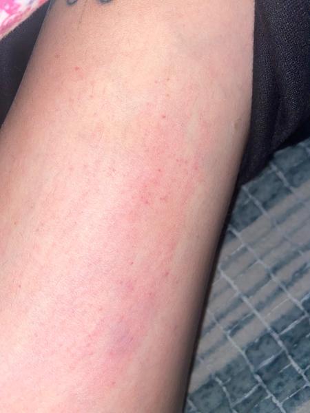 Svědění na těle. Může to být svrab?