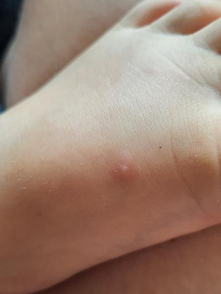 Varilrix očkování: Je možné se nakazit neštovicemi?